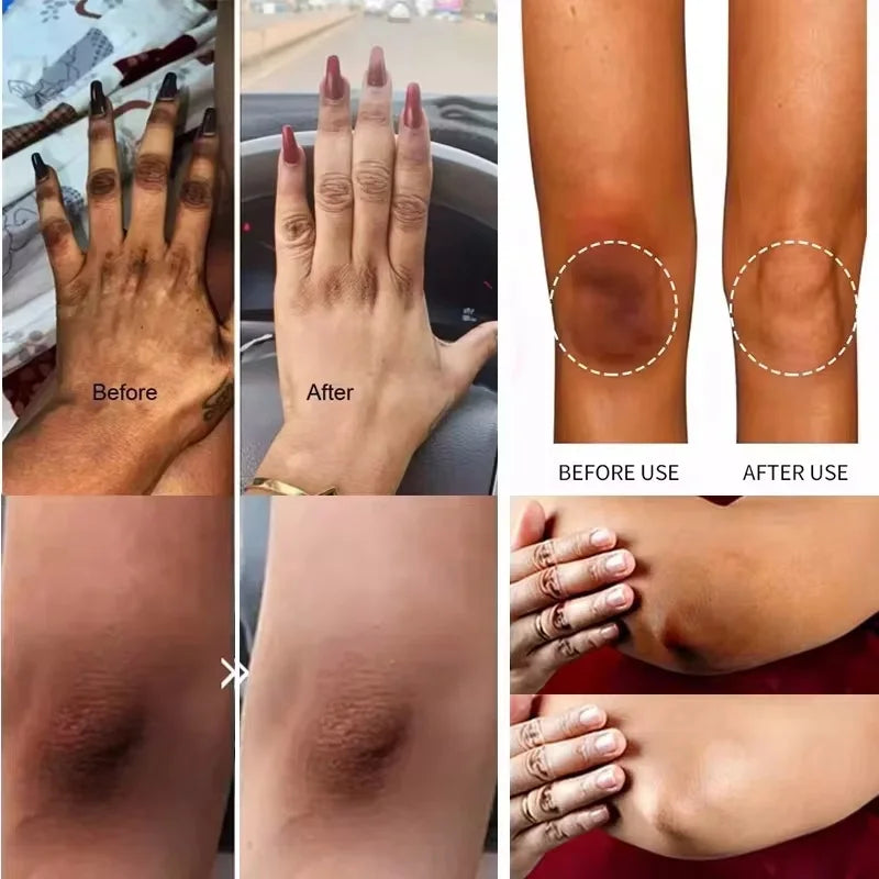 Dark Knuckles /Serum Elbows Hand Knuckle Stains Remover Essence